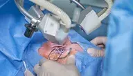 eye-laser-surgery-5016073_1280.webp