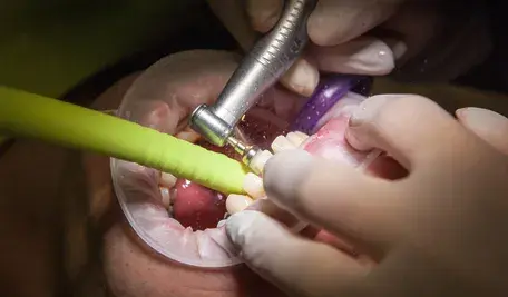 Po usunięciu zębów w tureckiej klinice powiedziano mu, że na implanty musi poczekać pół roku